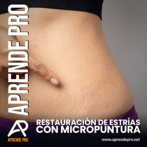 Restauración de Estrías con Micropuntura